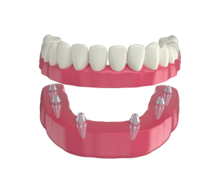 Имплантация All-on-6