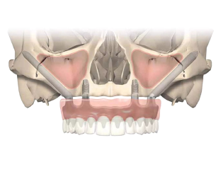 Скуловая имплантация Zygoma